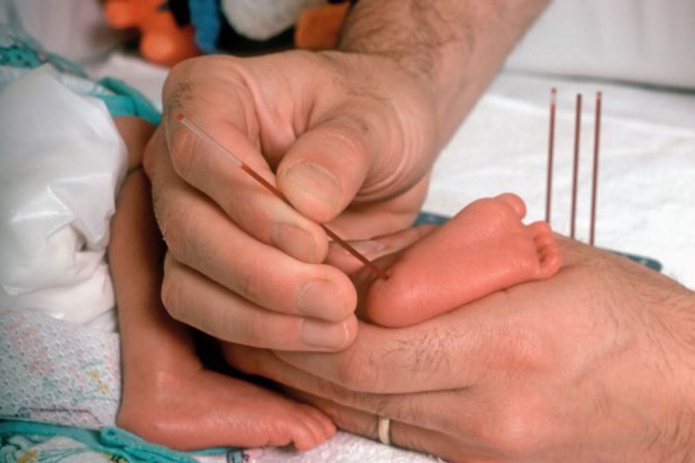 O traço falciforme pode ser precocemente diagnosticado através do teste do pezinho (Foto: Ministério da Saúde)